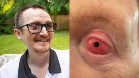 Side-by-side images showing Bent Chapman. On the left, he is smiling outdoors while wearing glasses, with a visible eye condition. On the right, a close-up of his red prosthetic eye implant with a black pupil is shown.