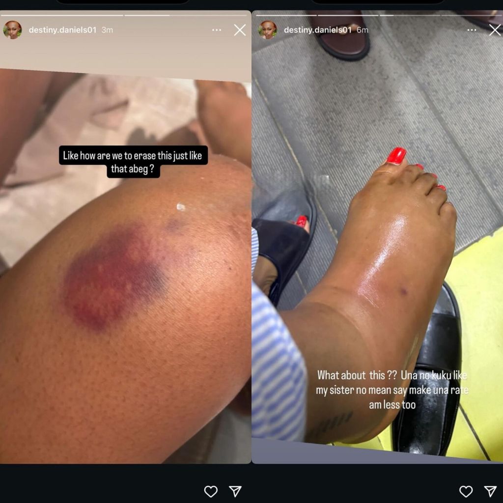 Regina Daniels injury photos